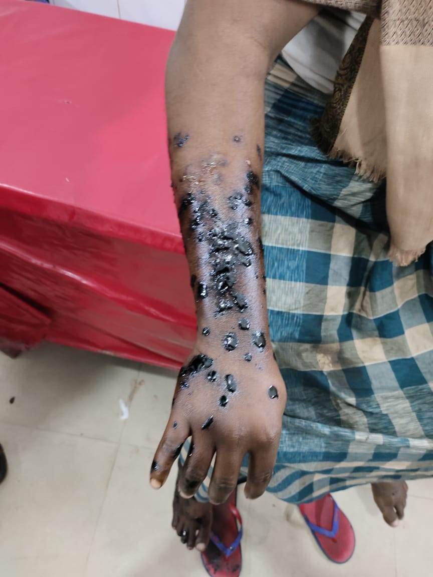 ভোলায় গরম বিটুমিন নিক্ষেপে ঝলসে গেলো অটো চালকের হাত-পা