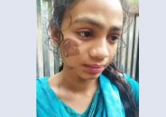মাদারীপুরে কিশোরীকে সৎ মায়ের গরম খুন্তির ছ্যাঁকা
