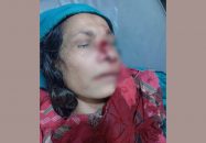 নাজিরপুরে প্রতিপক্ষের হামলায় গৃহবধূর নাক বিচ্ছিন্ন