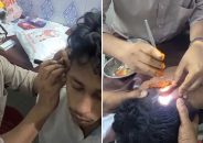 পুলিশের ভয়ে কানের ভেতর ইয়াবা, ৯ দিন পর অস্ত্রোপচার